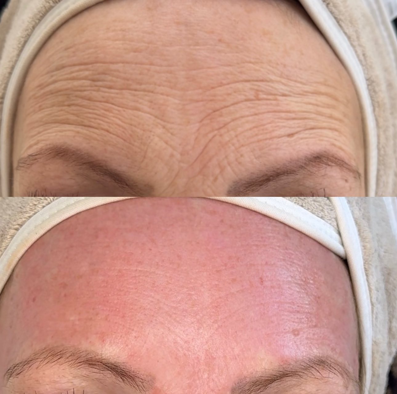 Facial treatment before and after
