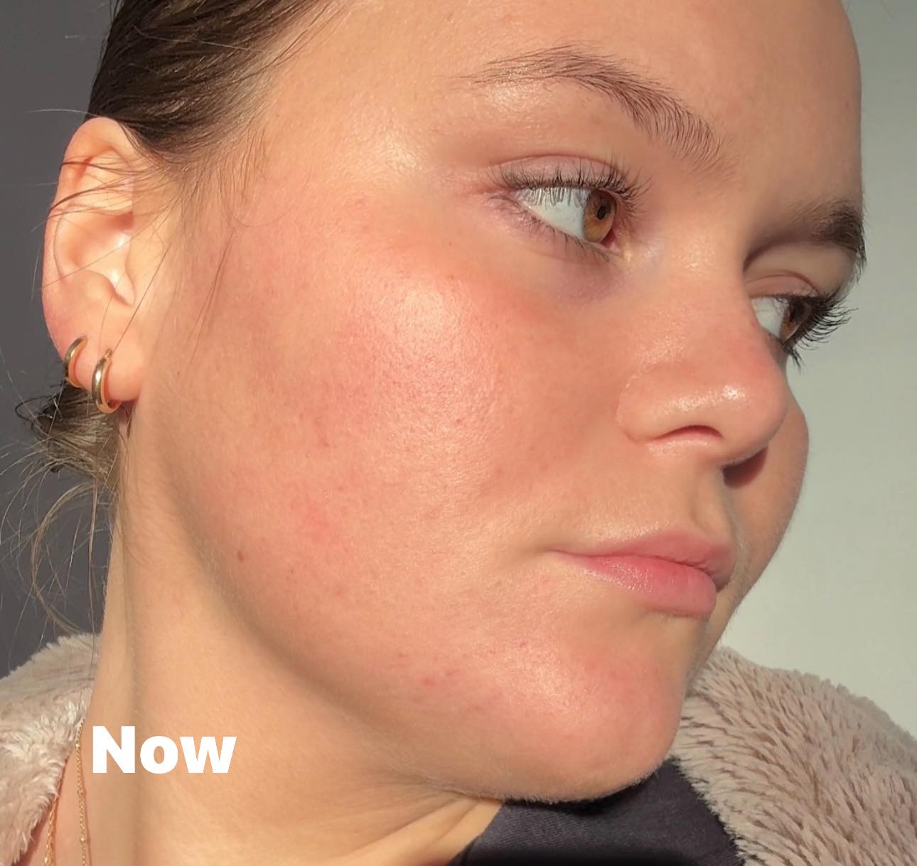 Beautiful skin result