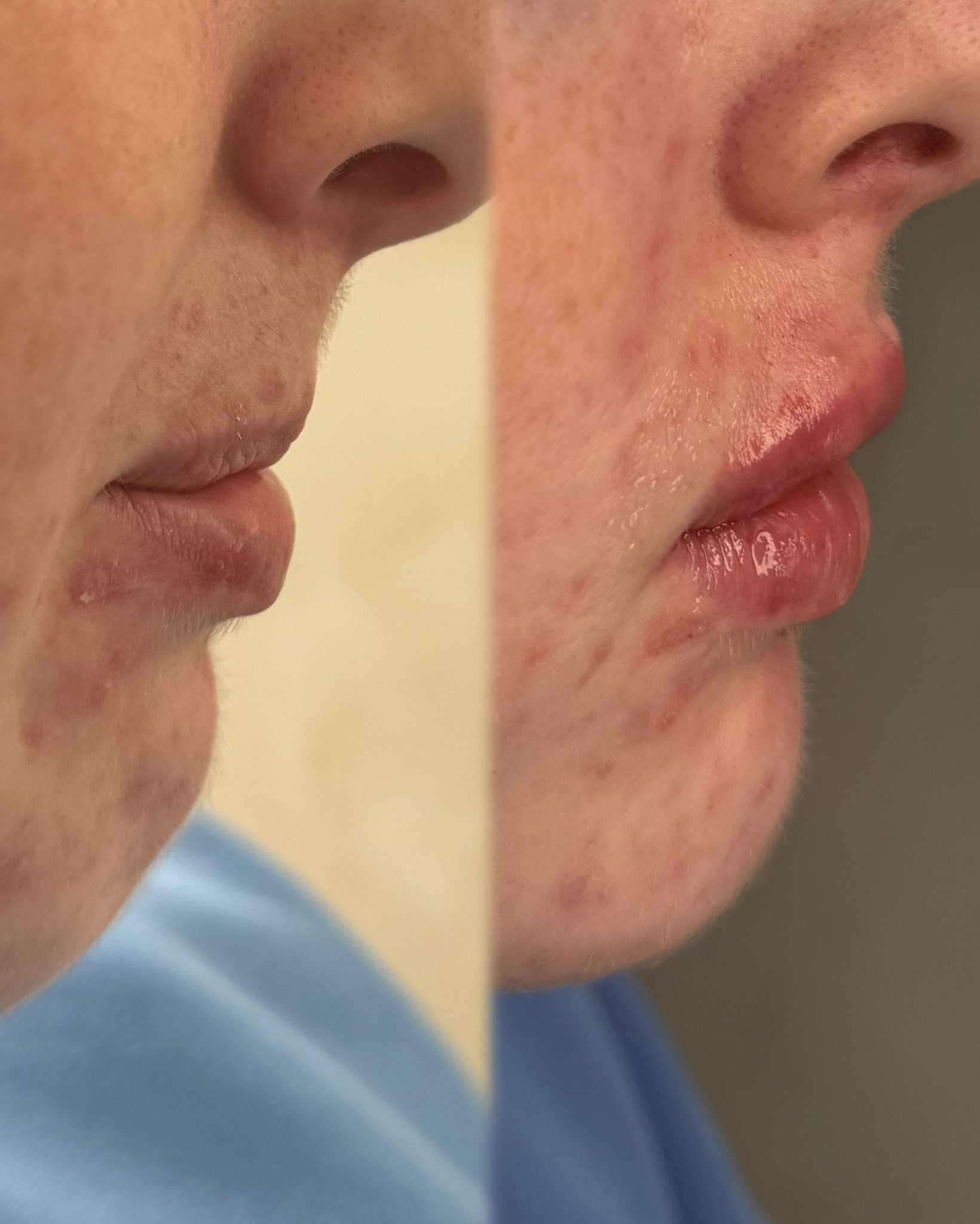 Lip and chin profile before and after