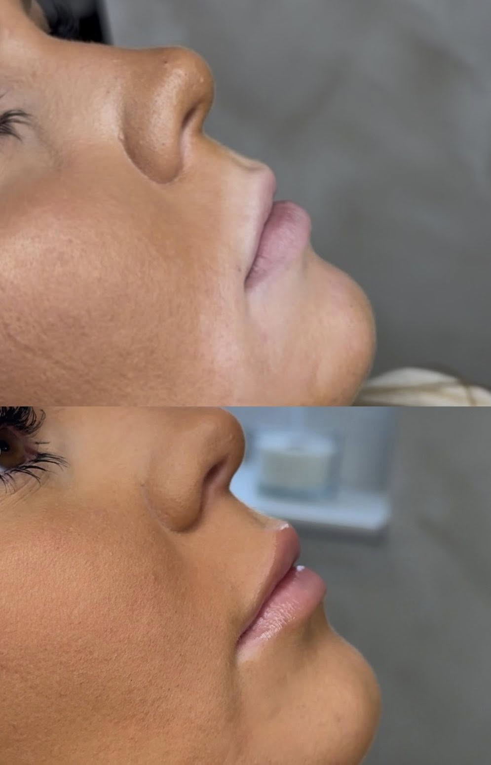 Acne Treatment Journey - Before and After