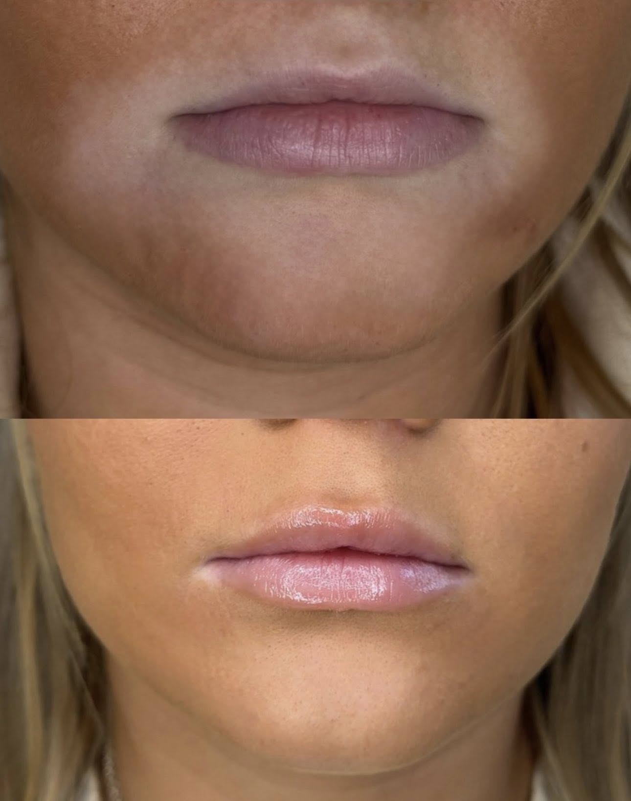 Lip filler enhancement
